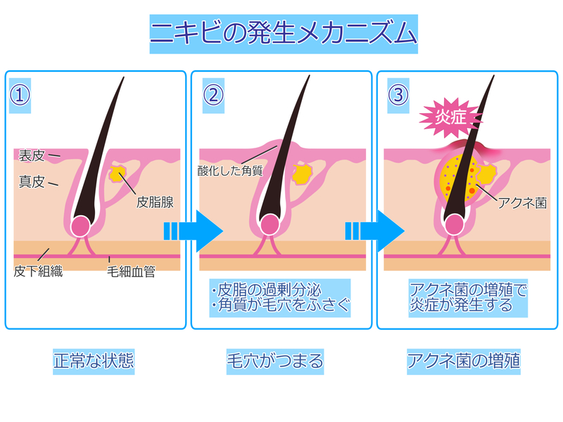 アクネ菌