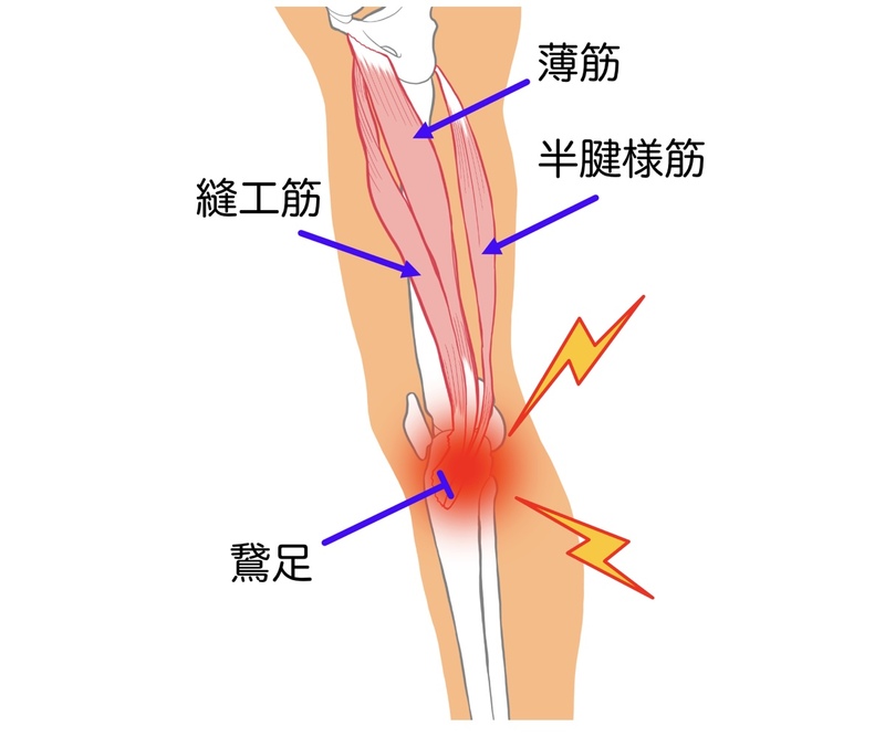 鵞足炎