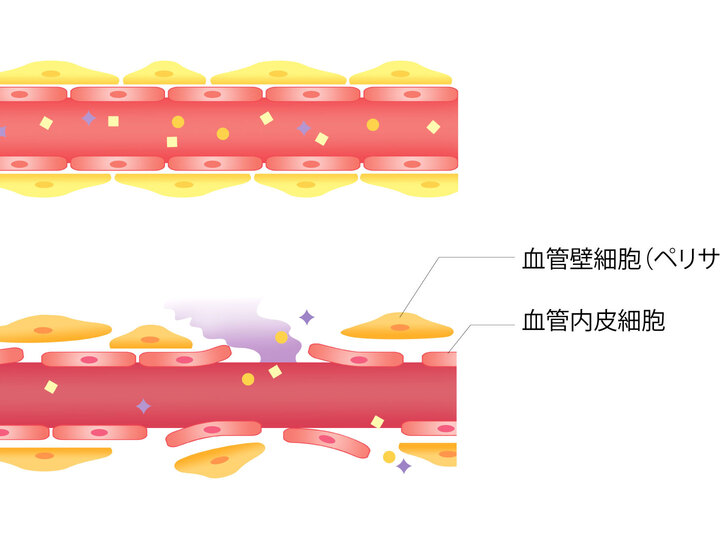 Covid 19とゴースト血管 後編 Yokare