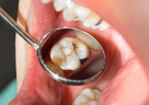 歯周病、虫歯予防にカテキンはどんな効果があるの？